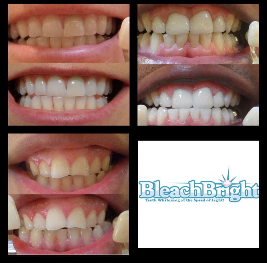 Before and after teeth whitening results in a collage with BleachBright logo.